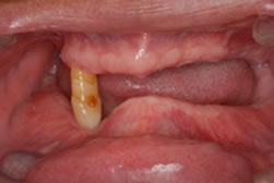 イボカップシステムによる義歯1
