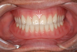 イボカップシステムによる義歯2