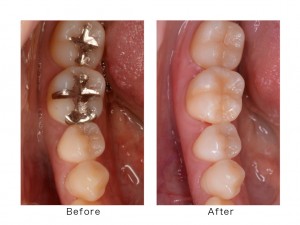 奥歯の審美治療〜銀歯をセラミックの白い歯へ〜