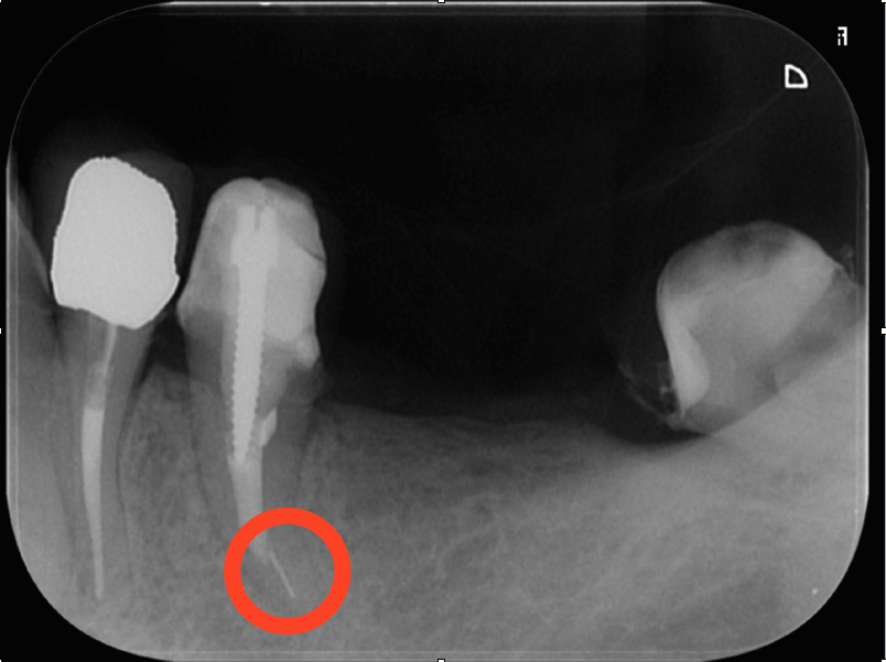 湾曲した歯の神経の治療