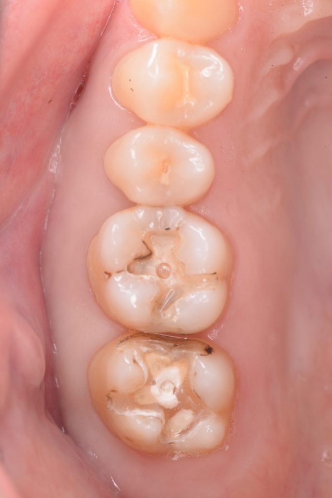 銀歯の下のむし歯の様子