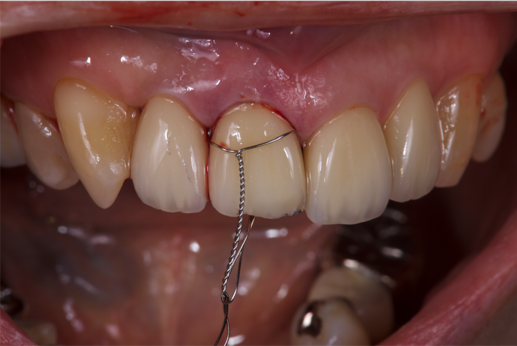 外傷歯の応急処置