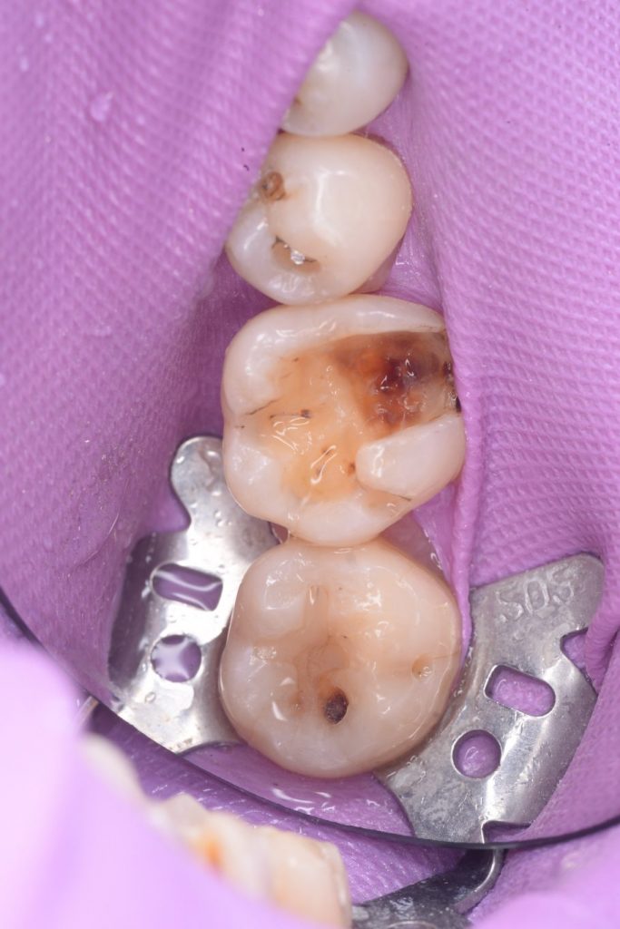 メタルインレーの下の虫歯の治療