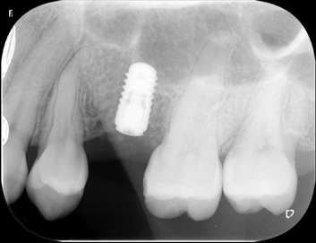 インプラント埋入後のレントゲン写真