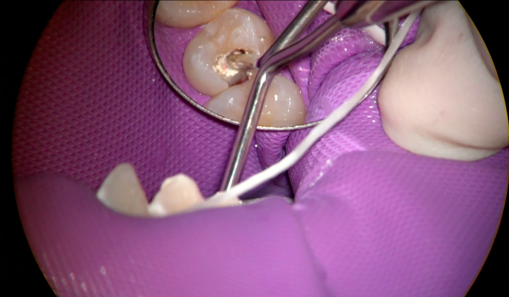 神経を残した歯の治療