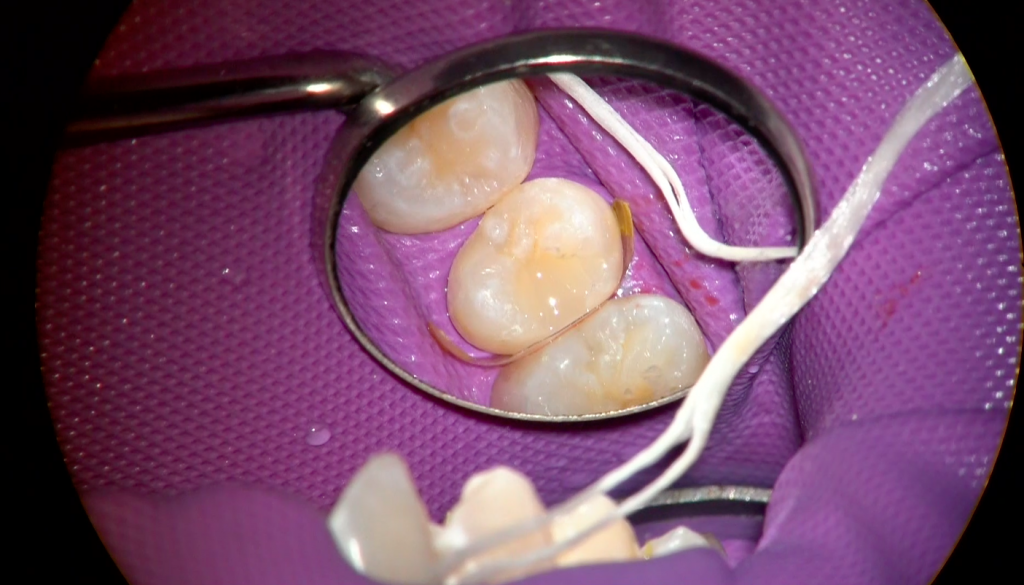 審美歯科の治療
