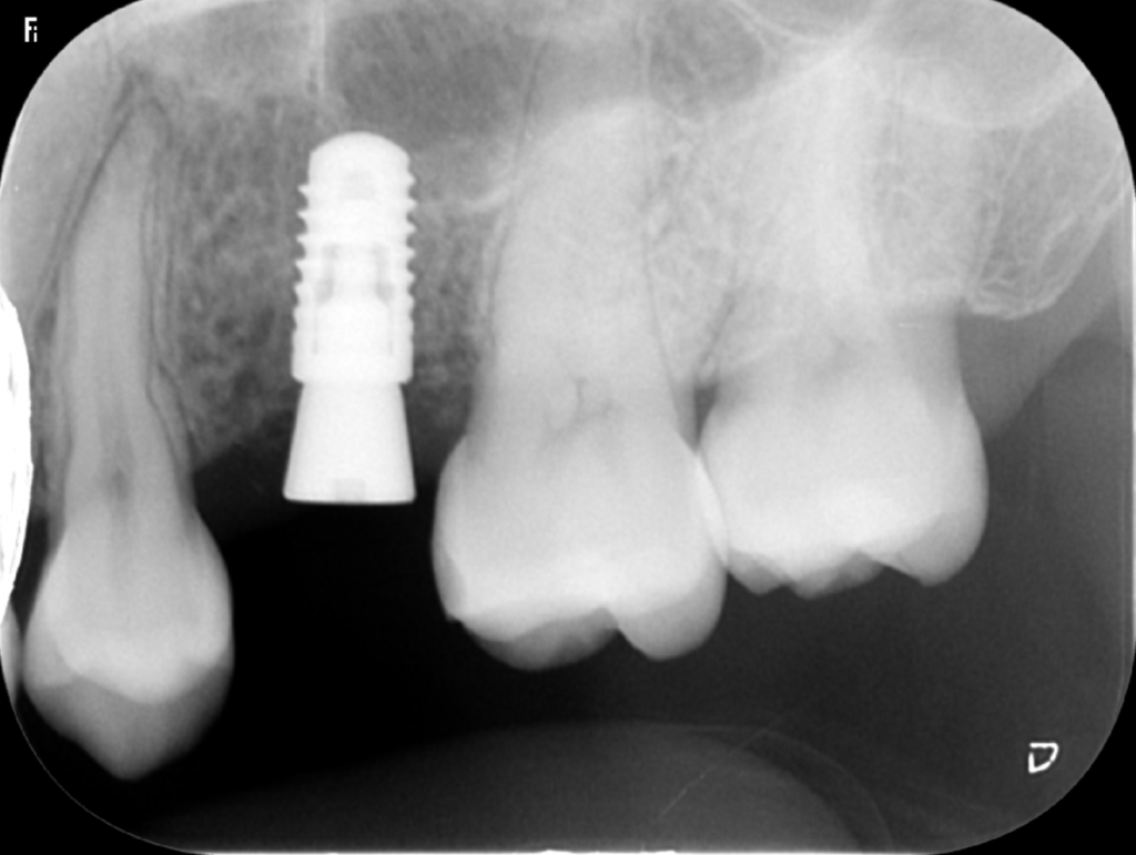 インプラントのレントゲン