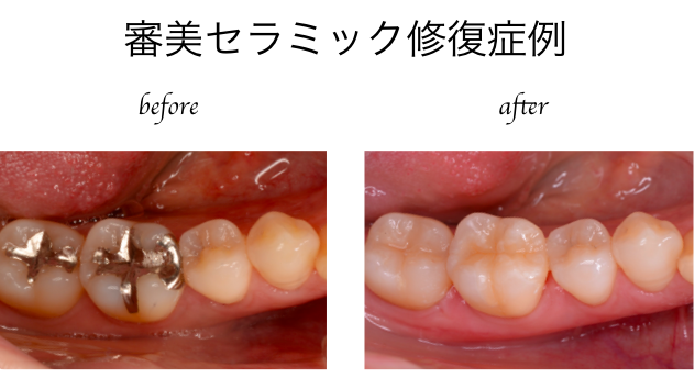 審美セラミック症例