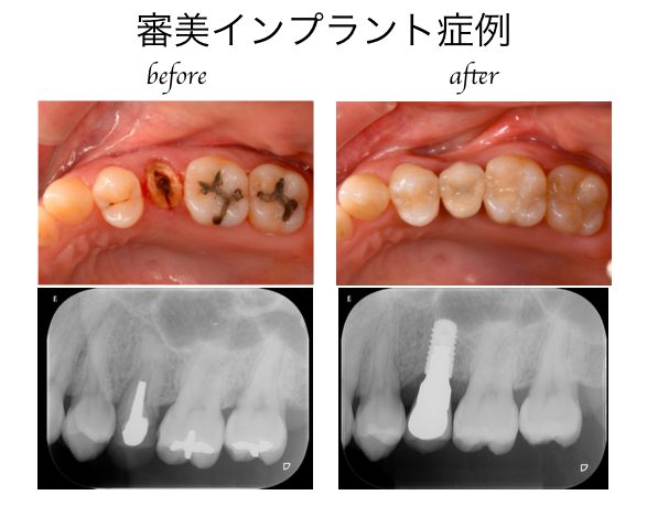 審美インプラント症例