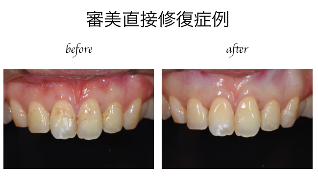 審美直接修復症例