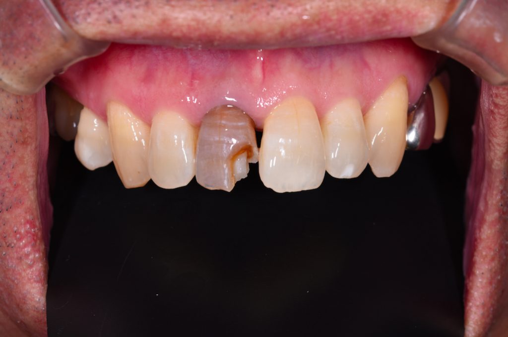 オールセラミック前歯部症例1