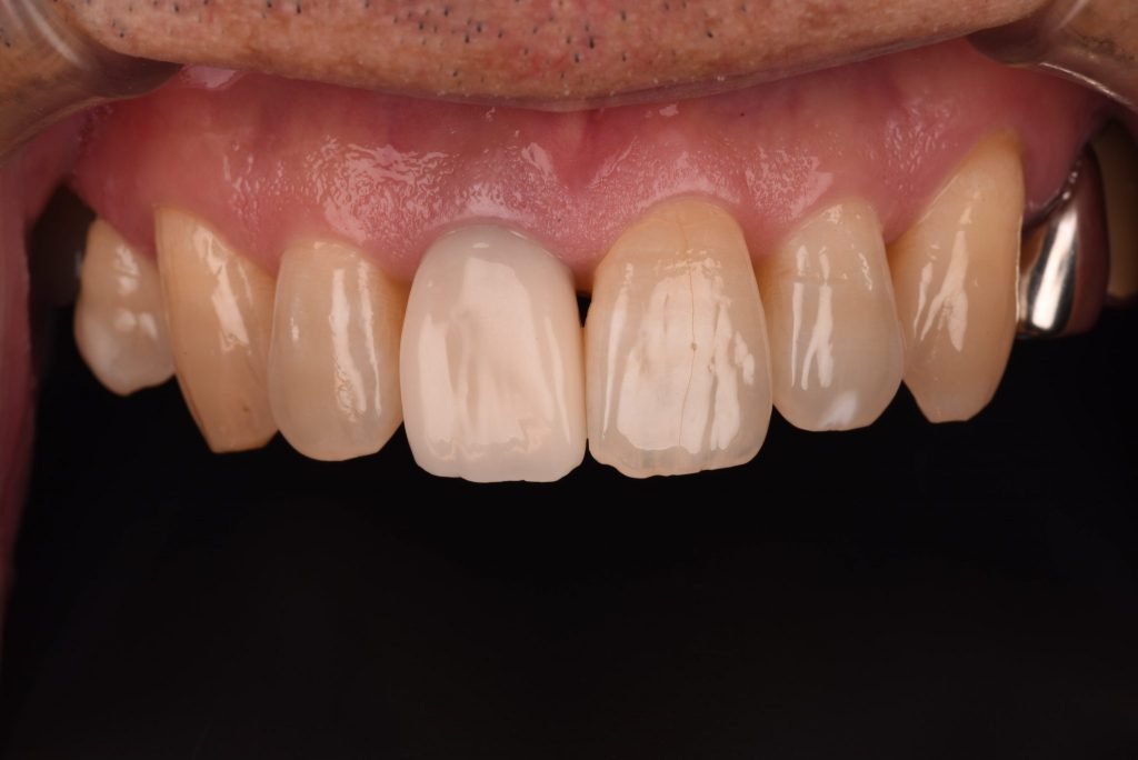 オールセラミック前歯部症例8