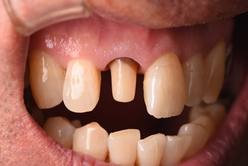 オールセラミック前歯部症例5
