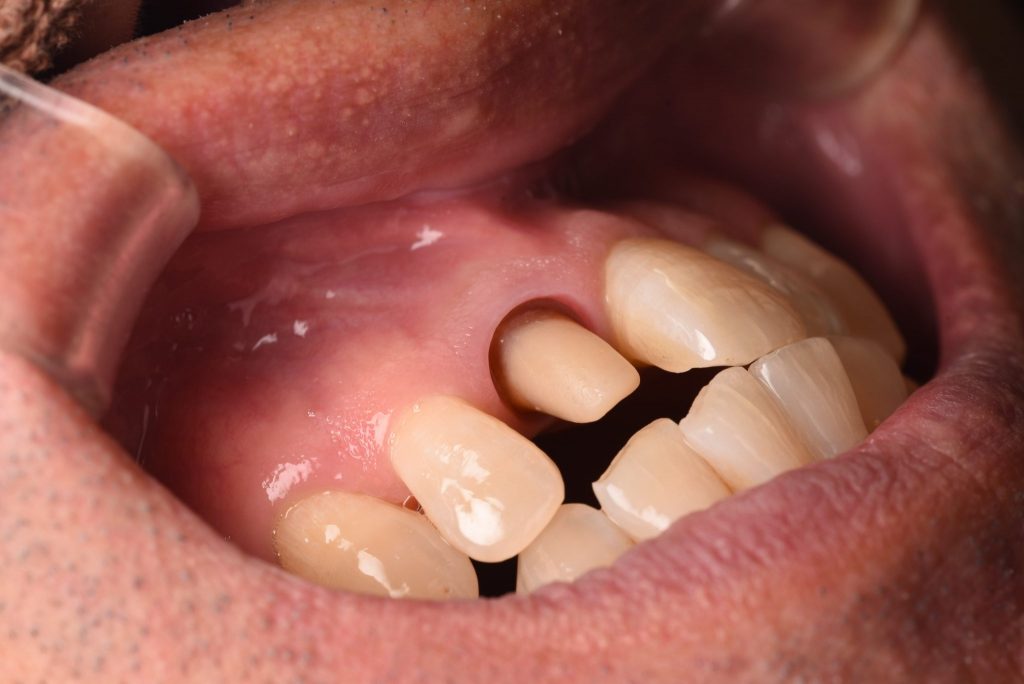 オールセラミック前歯部症例6