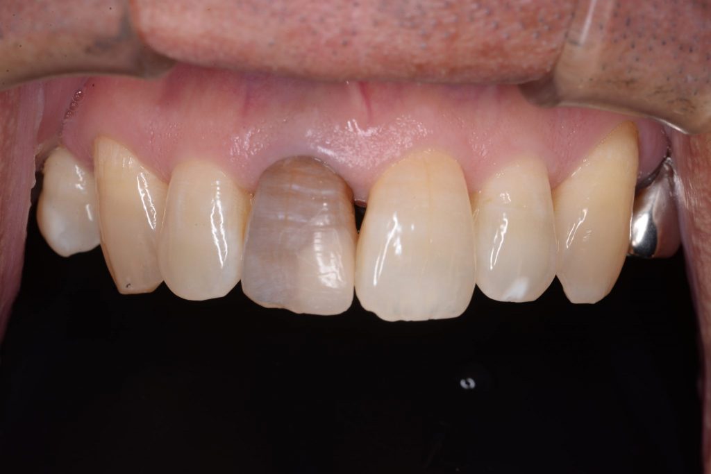 オールセラミック前歯部症例2