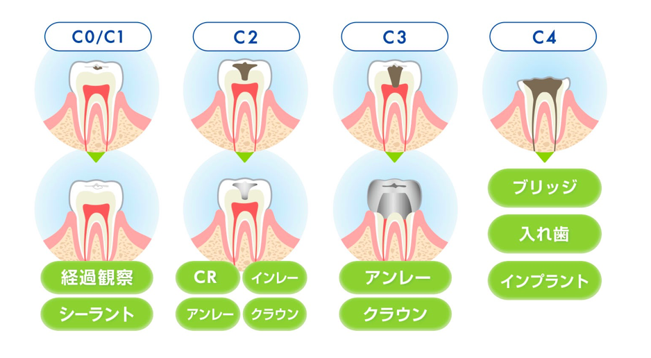 オールセラミック前歯部症例4