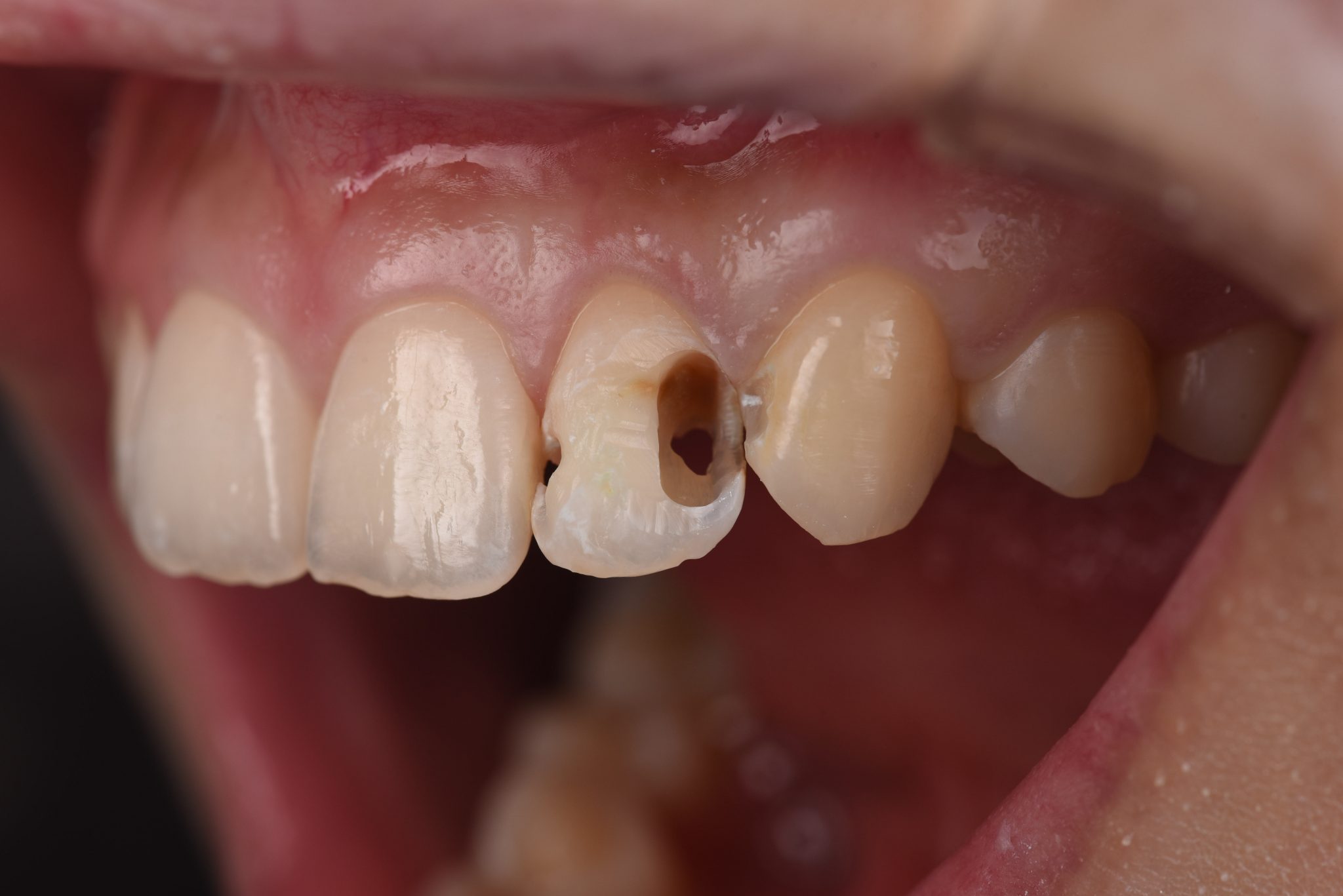 虫歯 神経 まで