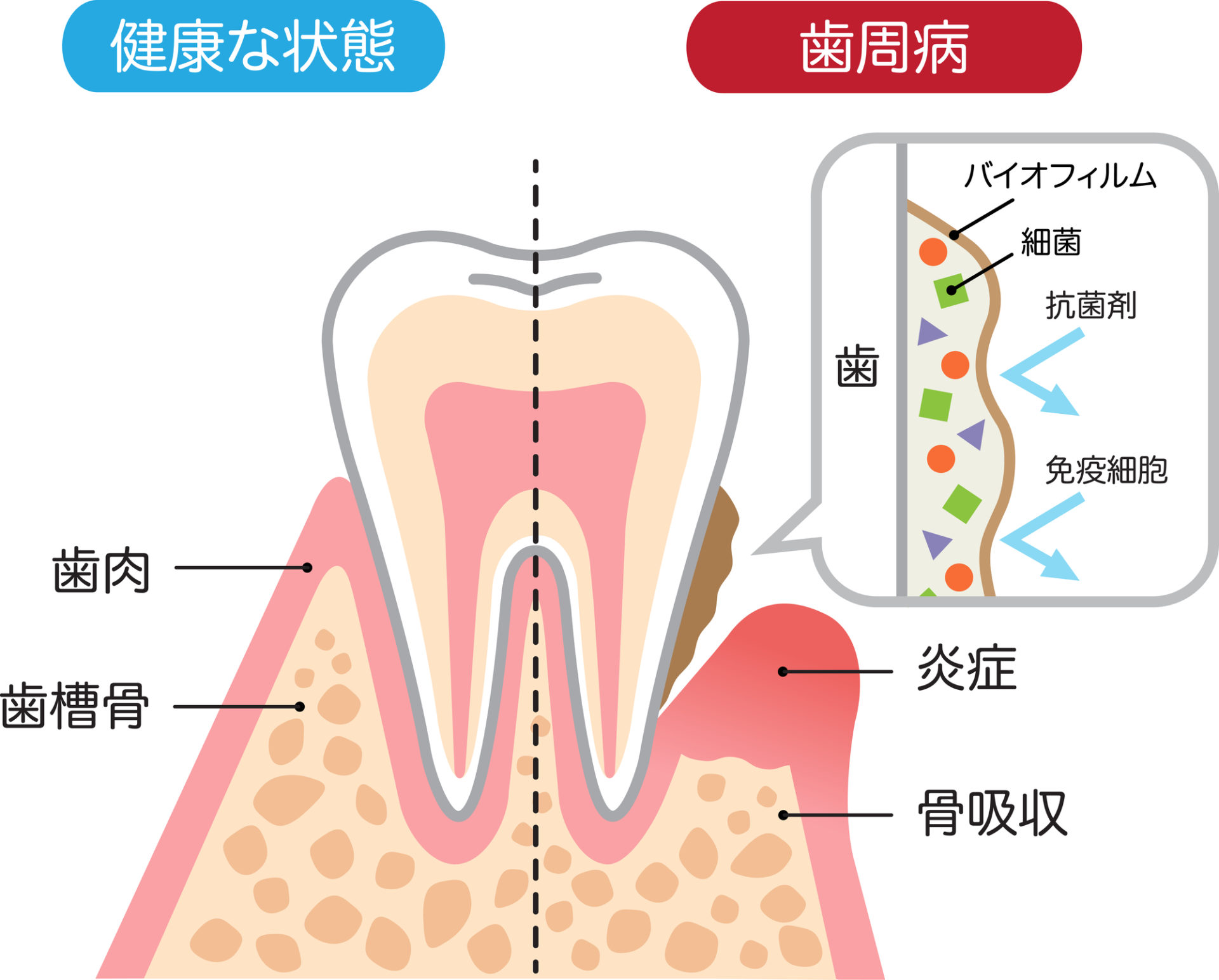 歯茎 押す と 痛い 前歯