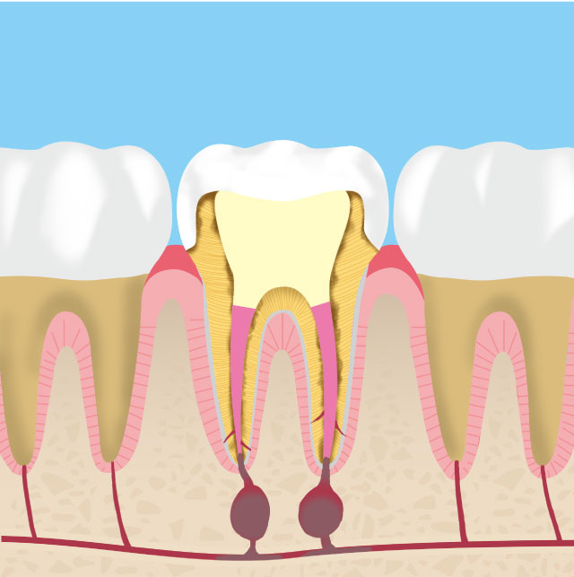 再治療が必要な歯の断面　イメージ