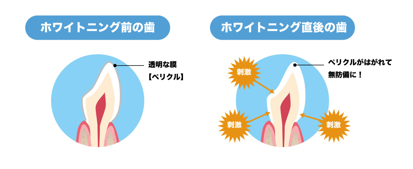 知覚過敏体質の方はホワイトニングでしみやすい 原因 ひろた哲哉歯科・矯正歯科