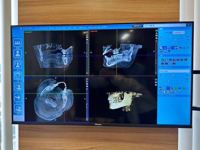 CTでの精密な診断 ひろた哲哉歯科・矯正歯科
