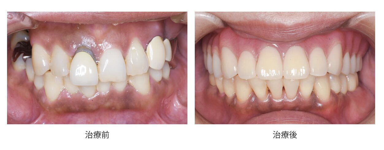 福岡市南区 全顎治療(フルマウス治療) インプラント 矯正 補綴 症例 ひろた哲哉歯科・矯正歯科