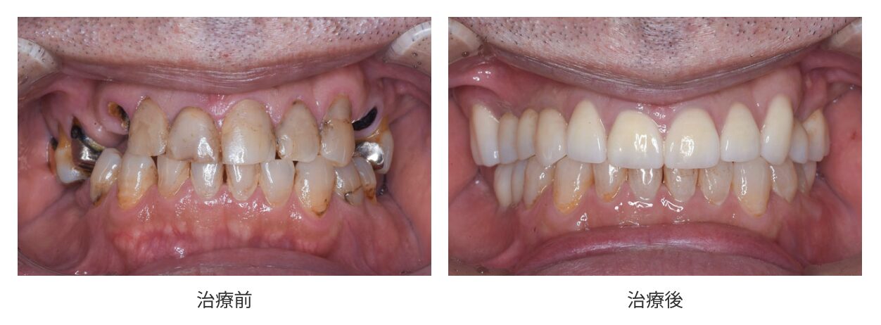 福岡市南区 全顎治療(フルマウス治療) インプラント 矯正 補綴 症例 ひろた哲哉歯科・矯正歯科
