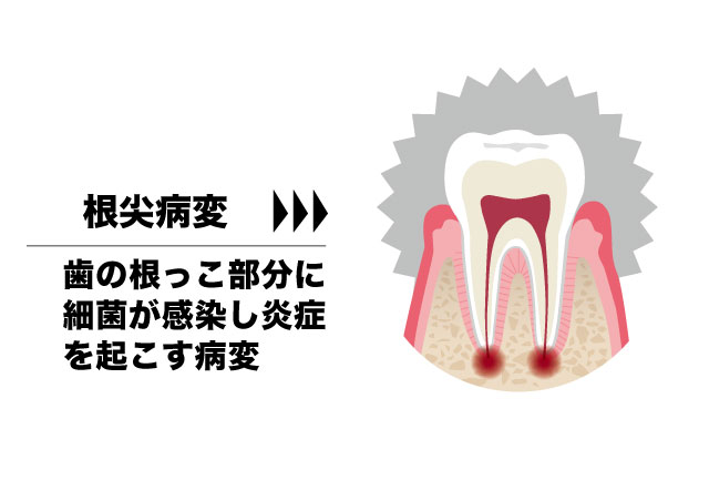 根尖病変のイラスト ひろた哲哉歯科・矯正歯科