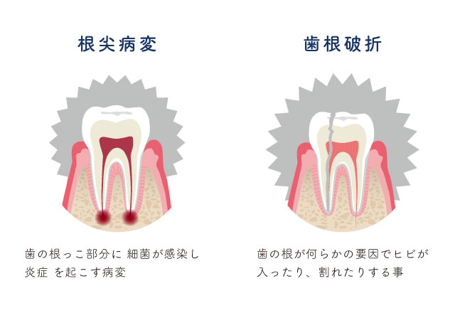 歯根破折と根尖病変のイメージイラスト　ひろた哲哉歯科・矯正歯科