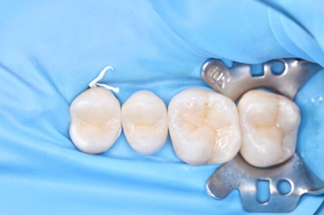 セラミックの接着治療された歯　ひろた哲哉歯科・矯正歯科