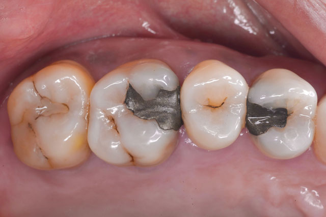 合着された銀歯の写真　ひろた哲哉歯科・矯正歯科