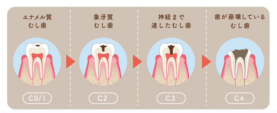 健康な歯が虫歯になっていくイメージ図　ひろた哲哉歯科・矯正歯科