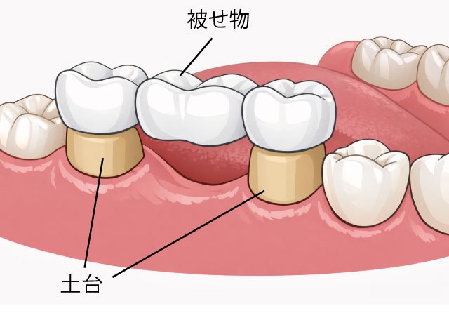 ブリッジ　治療イメージイラスト　ひろた哲哉歯科・矯正歯科