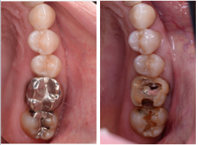 銀歯の下にできた虫歯　症例写真　ひろた哲哉歯科・矯正歯科