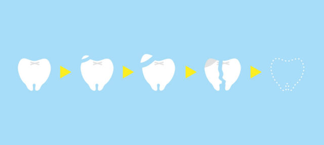 歯がなくなっていく過程のイラスト　ひろた哲哉歯科・矯正歯科