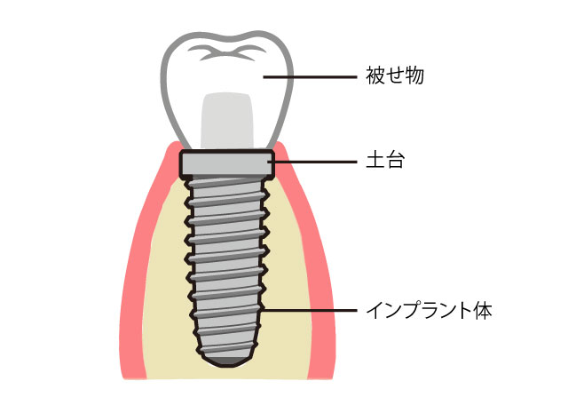 インプラントの構造イラスト　ひろた哲哉歯科・矯正歯科
