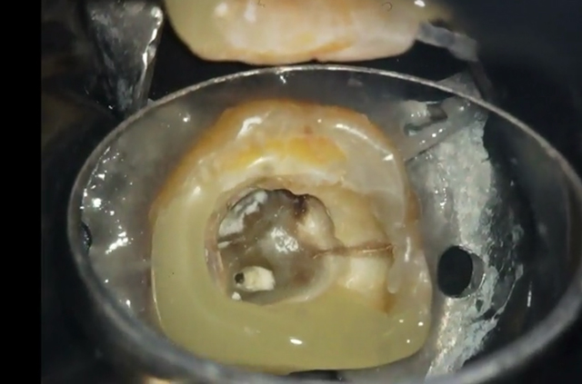 マイクロスコープで覗いた歯の様子