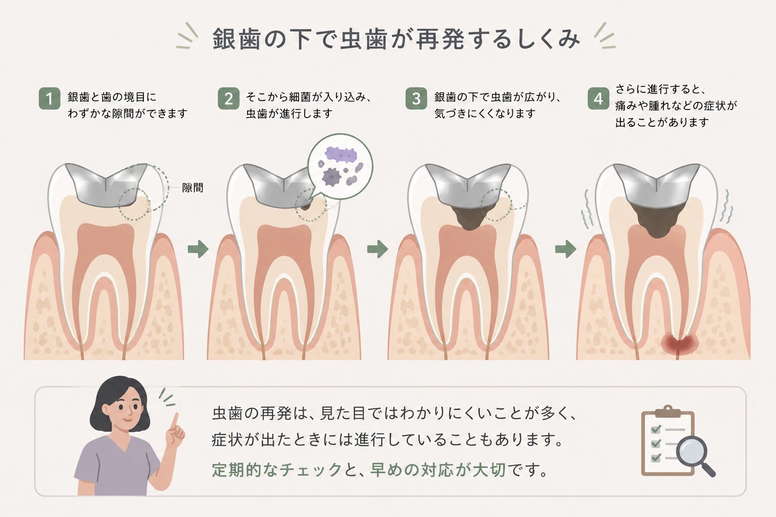 銀歯の下で虫歯が再発する模式図
