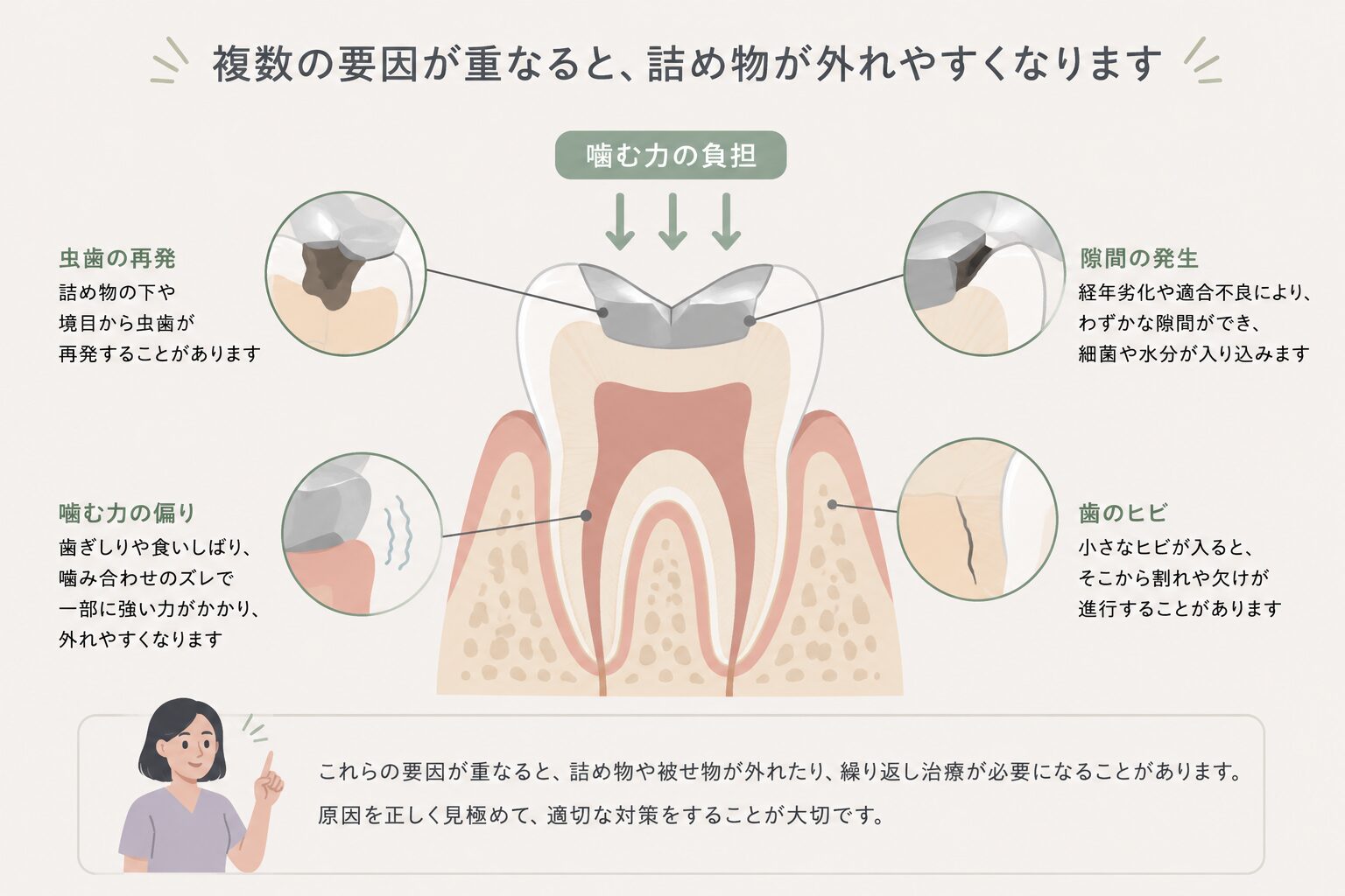詰め物が外れる原因　イラスト解説